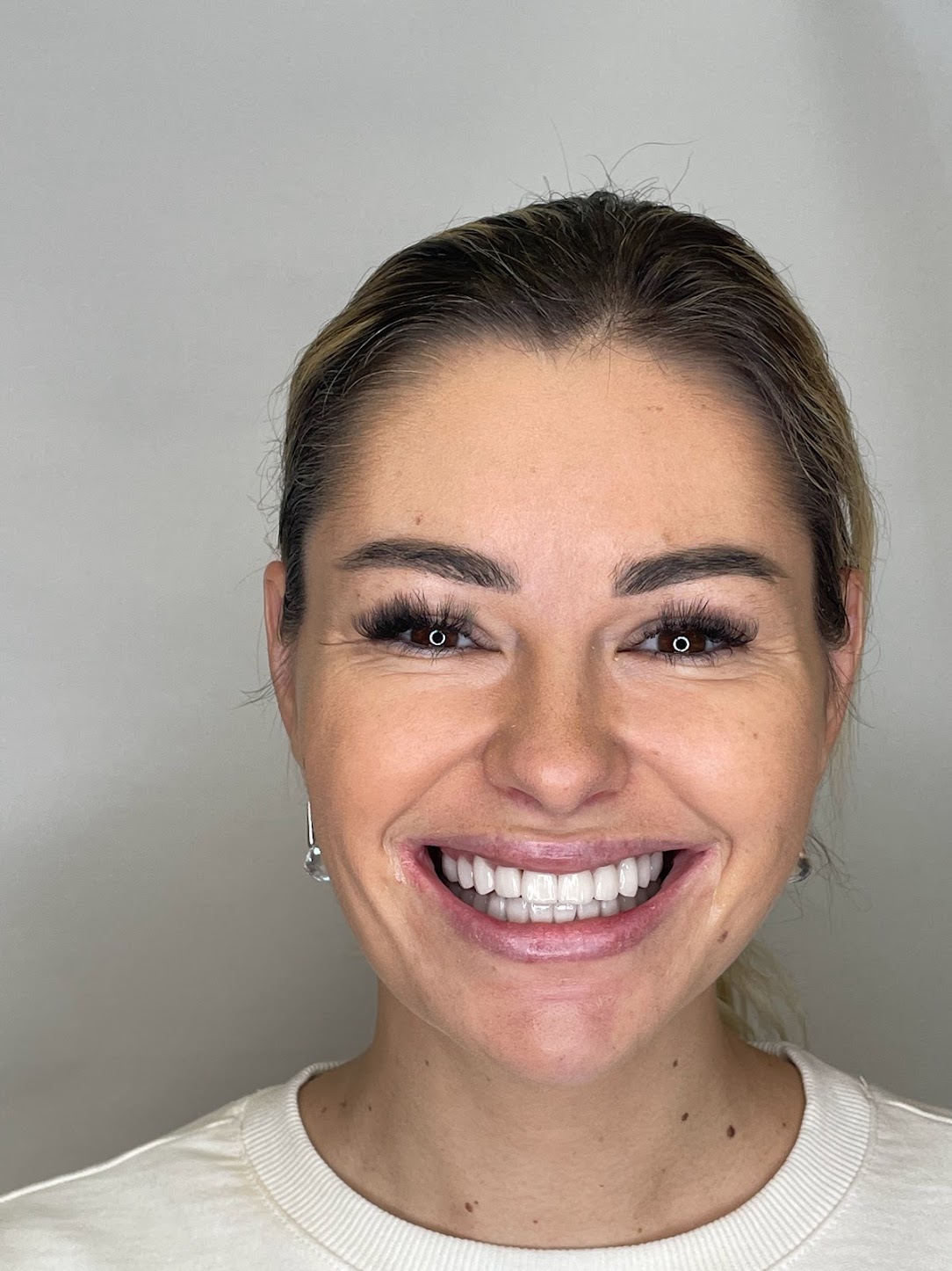 Bernadett — SolDent páciens
