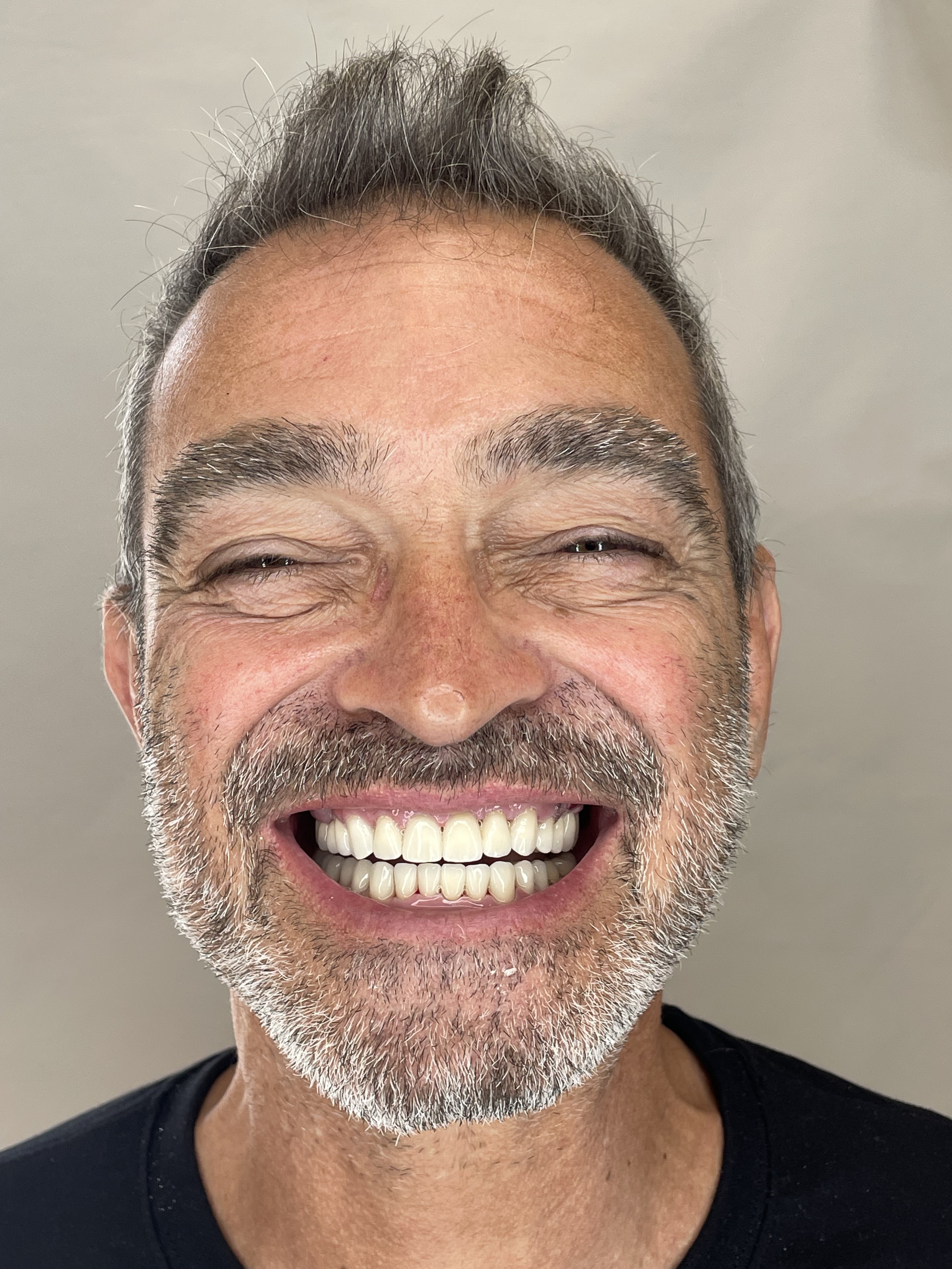 Porcelán héj eredmény