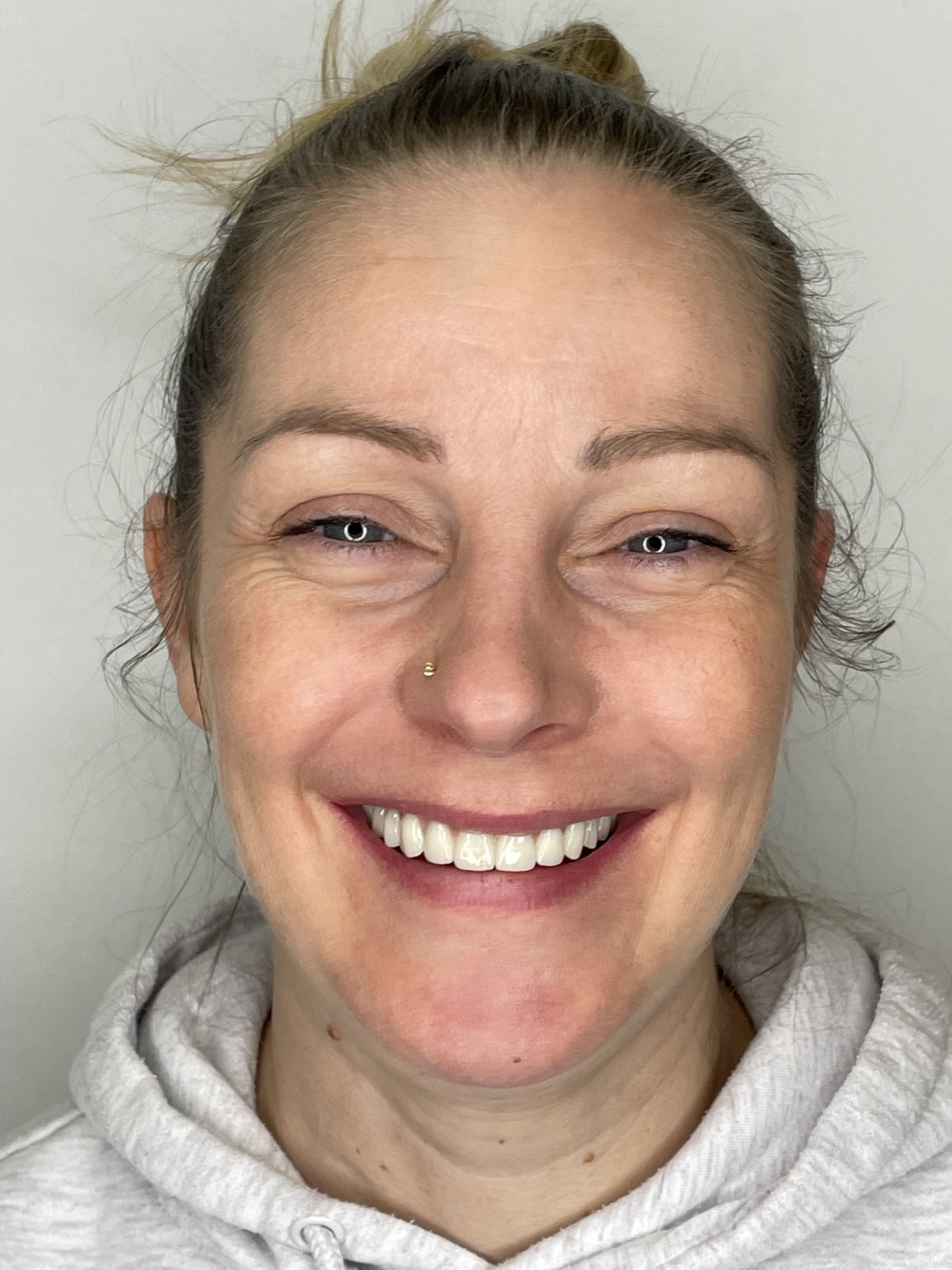 Emeline — elégedett páciens, Franciaország