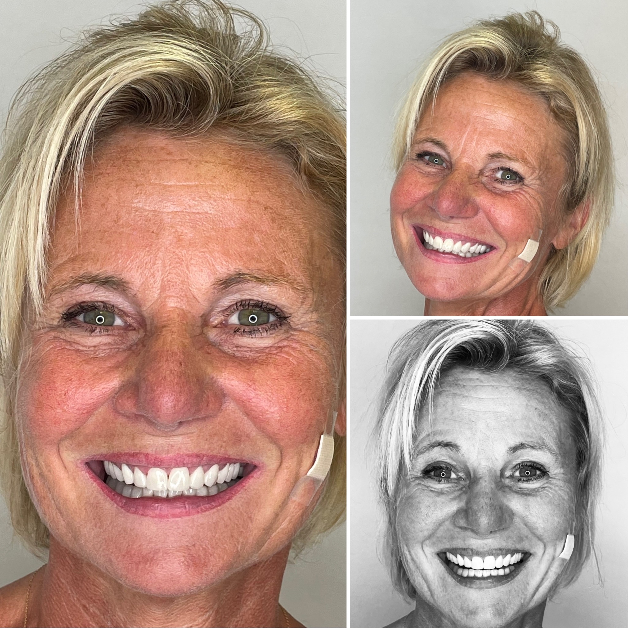 Hollywood smile